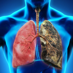 Yearly Lung Cancer Scans Are Advised for People 50 and Over With Shorter Smoking Histories image.